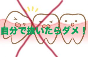親知らずを自分で抜くのは危険と言われ歯医者で抜歯したが膿んで痛みが治まらない体験談 アリカワブログ 親知らずを自分で抜くのは危険と言われ歯医者で抜歯したが膿んで痛みが治まらない体験談 アリカワブログ