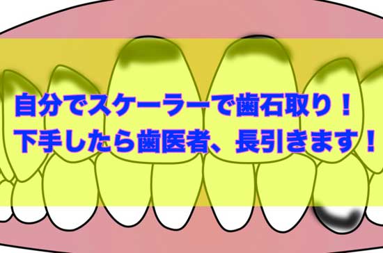 「鎌形スケーラーで自分で歯石を除去しようとして歯がボロボロになった！」のアイキャッチ画像